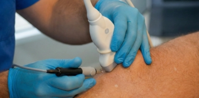 Fisioterapeuta en mostoles haciendo Electrolisis percutanea o tecnica EPI en un tendon