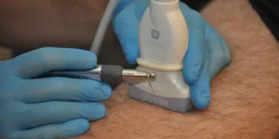 Fisioterapeuta en fisioterapia oceano aplicando Neuromodulación Percutánea Ecoguiada en un paciente