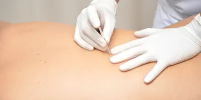 Fisioterapeuta en fisioterapia oceano aplicando Punción seca en un paciente